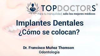 Implantes dentales sin dolor ¿cómo se colocan [upl. by Annaj278]