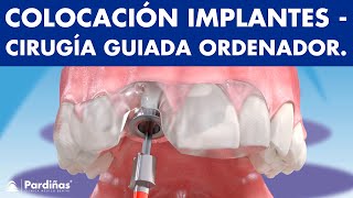 Cirugía guiada por ordenador para colocar IMPLANTES DENTALES© [upl. by Nadruoj]