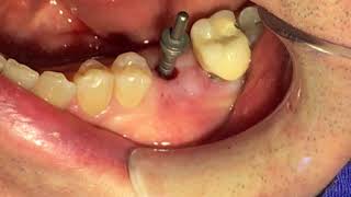 FLAPLESS IMPLANT Implante dental con una técnica sin colgajo [upl. by Udela]